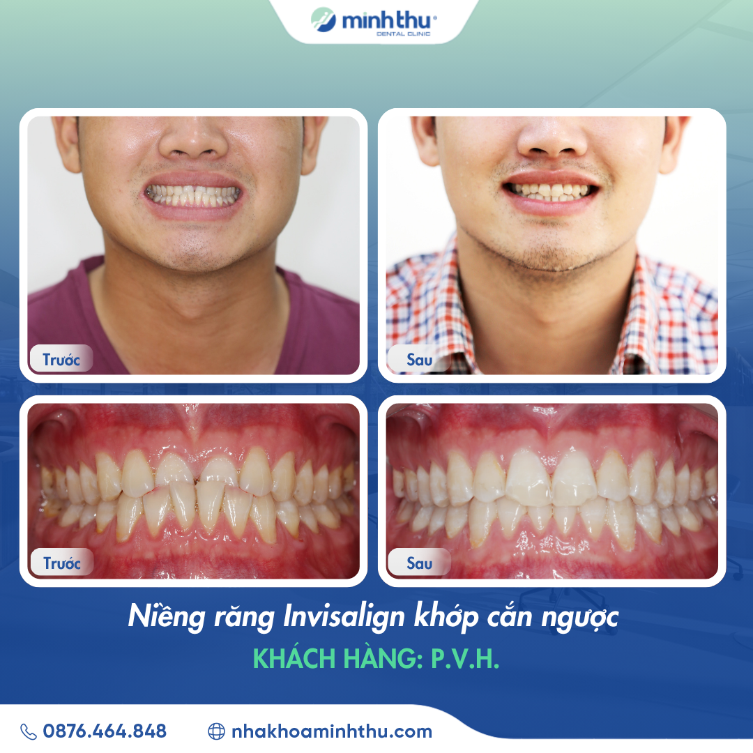 nieng-rang-invisalign-khop-can-nguoc-tại-nha-khoa-minh-thu