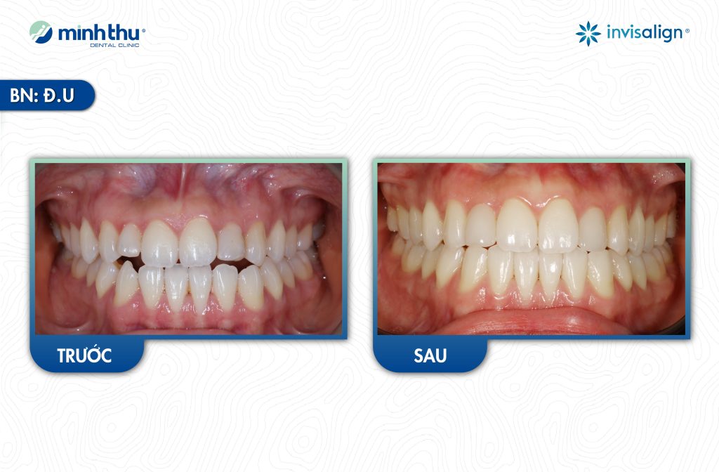 nieng-rang-invisalign-khop-can-doi-dinh-tại-nha-khoa-minh-thu