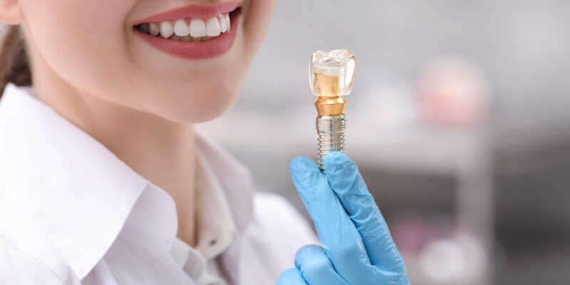 cấy ghép Implant Long Biên