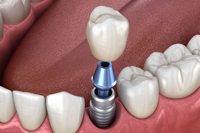 6-yeu-to-quyet-dinh-do-ben-cua-tru-implant-bi-quyet-giup-implant-su-dung-tron-doi (7)