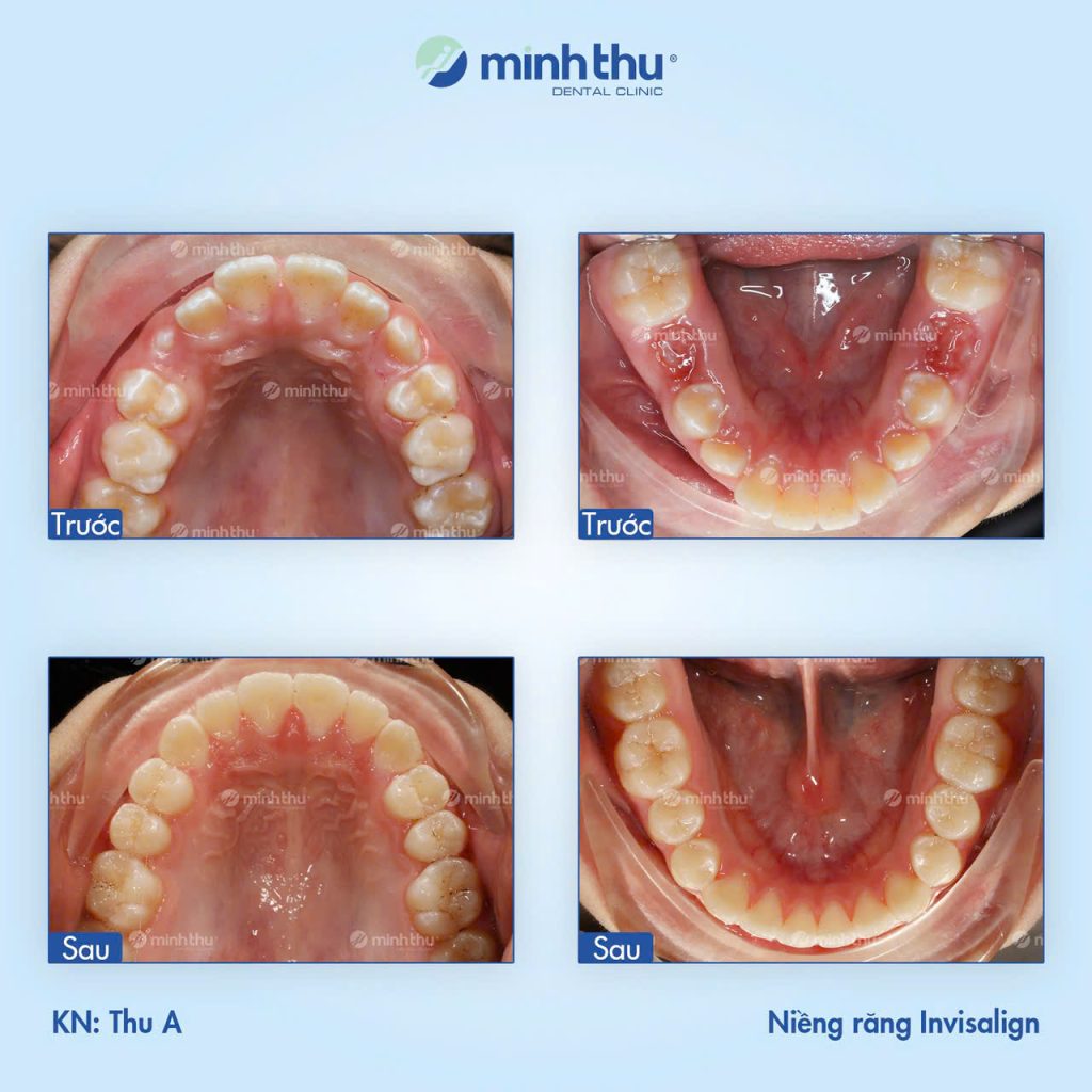 can-thiep-som-la-de-bot