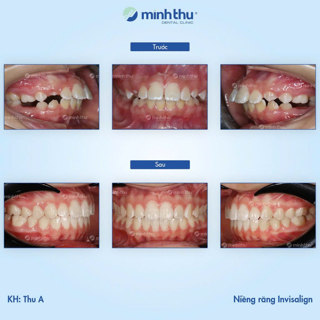 can-thiep-som-la-de-bot