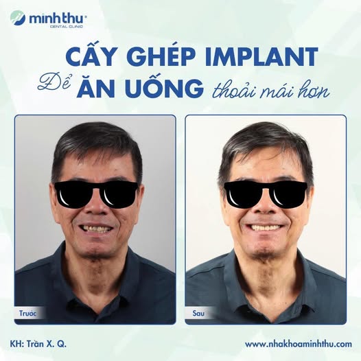 cay-ghep-implant-nha-khoa-minh-thu