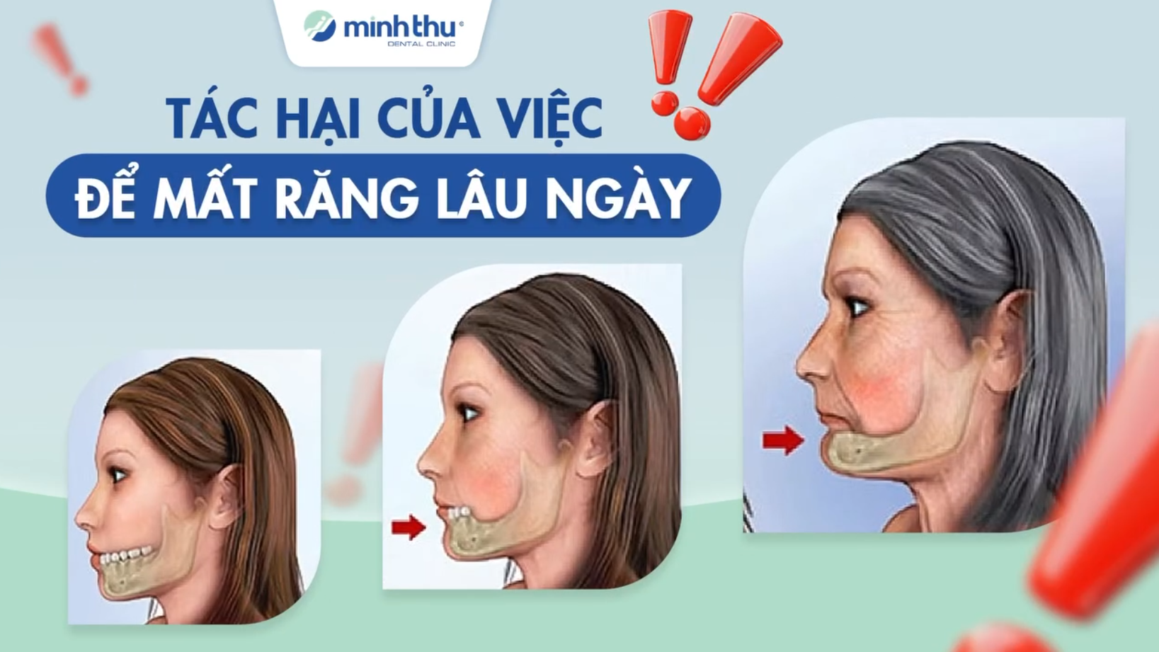 cay-ghep-implant-nha-khoa-minh-thu