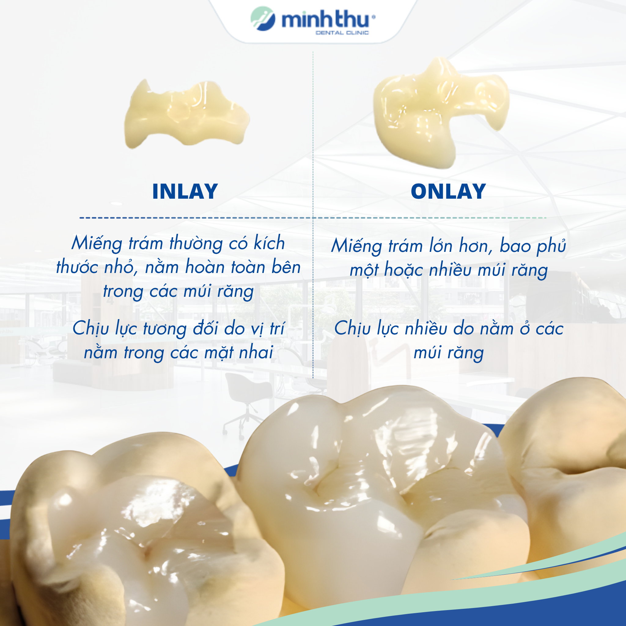 inlay-onlay-cho-rang-sau-rang-vo
