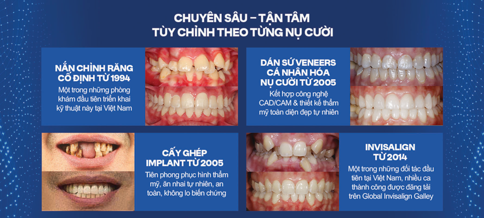 nha-khoa-minh-thu-tien-phong-nieng-rang