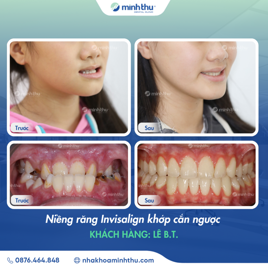 nieng-rang-invisalign-khop-can-nguoc-tai-nha-khoa-minh-thu