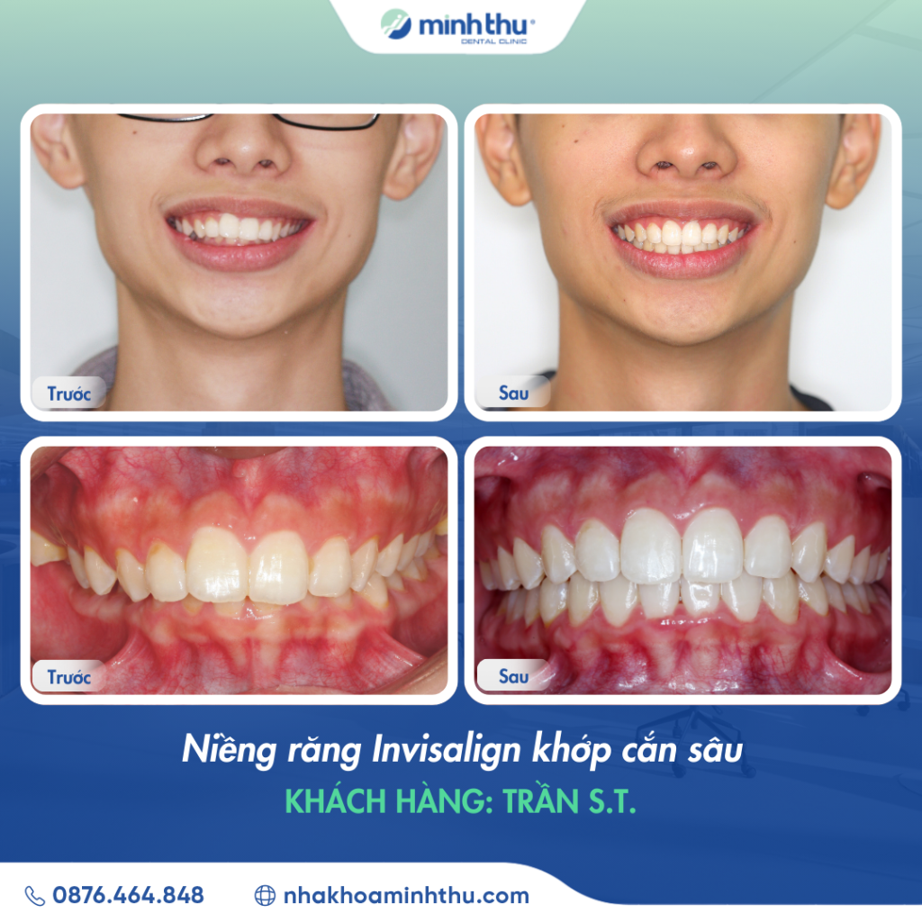 nieng-rang-invisalign-khop-can-sau-tại-nha-khoa-minh-thu