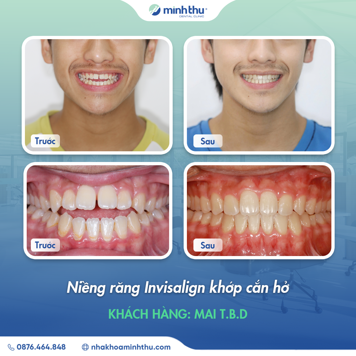 nieng-rang-invisalign-khop-can-ho-tại-nha-khoa-minh-thu