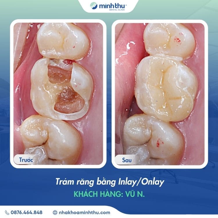 sau-rang-nguyen-nhan-dieu-tri-bang-inlay-onlay