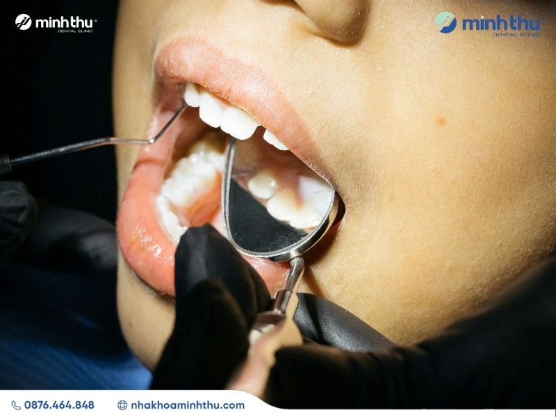 mom-rang-dieu-tri-hieu-qua