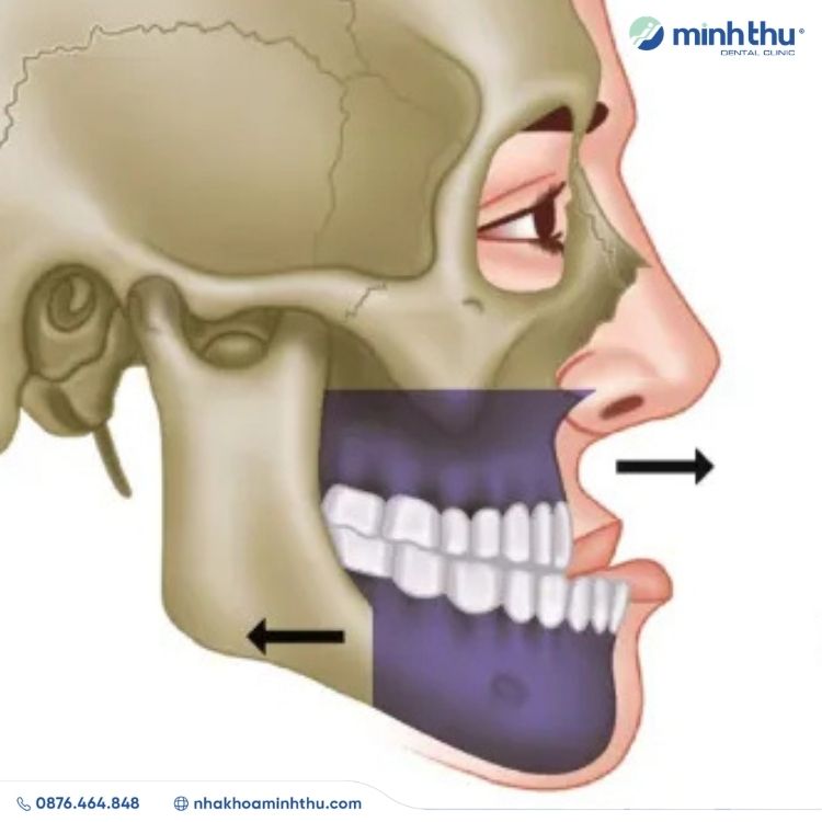 mom-rang-dieu-tri-hieu-qua
