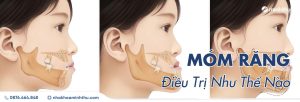 mom-rang-dieu-tri-hieu-qua