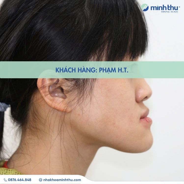 mom-rang-dieu-tri-hieu-qua