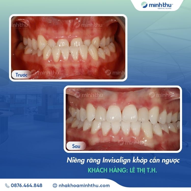 mom-rang-dieu-tri-hieu-qua