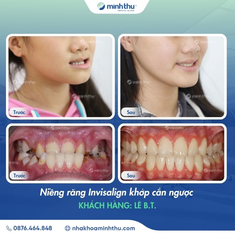 mom-rang-dieu-tri-hieu-qua