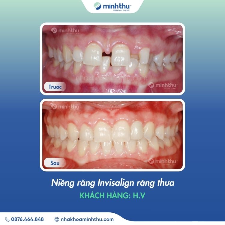 rang-bi-thua-nguyen-nhan-giai-phap