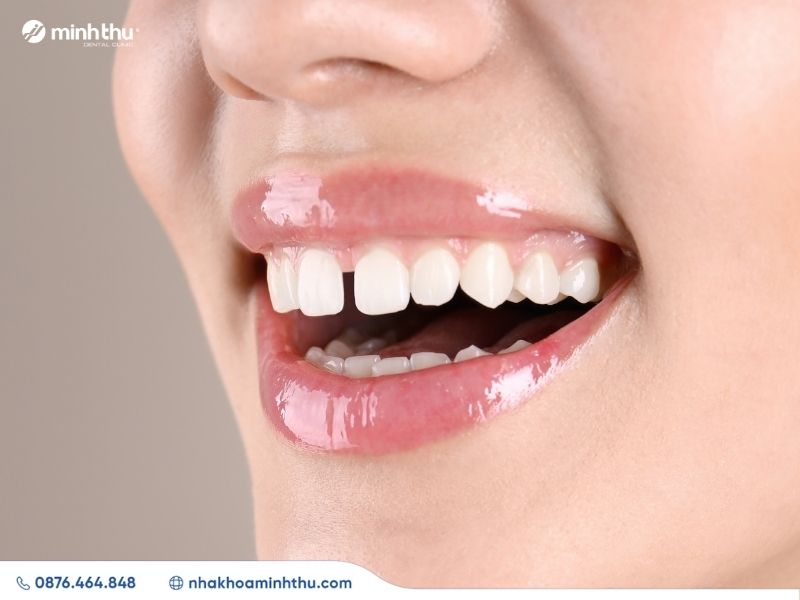 rang-bi-thua-nguyen-nhan-giai-phap