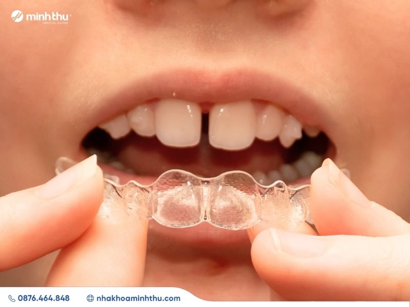 rang-bi-thua-nguyen-nhan-giai-phap