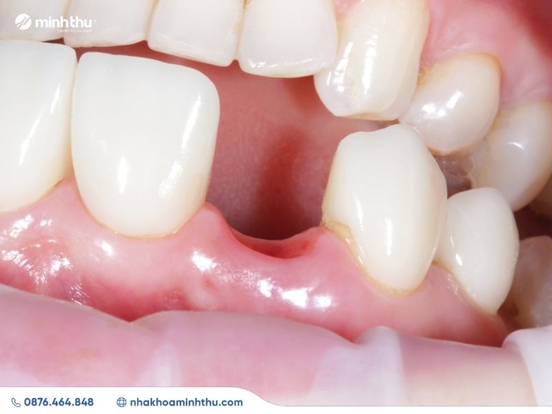 rang-bi-thua-nguyen-nhan-giai-phap