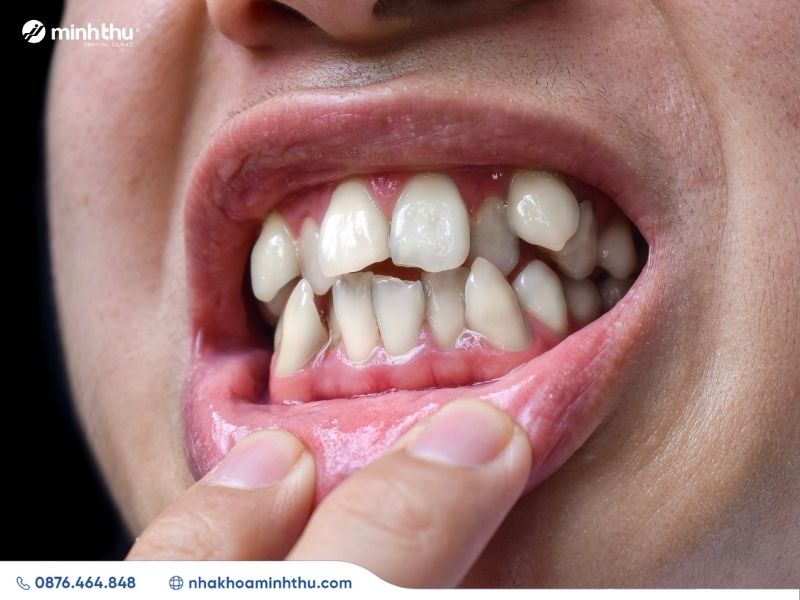 rang-khap-khenh-nguyen-nhan-phuong-phap-dieu-tri