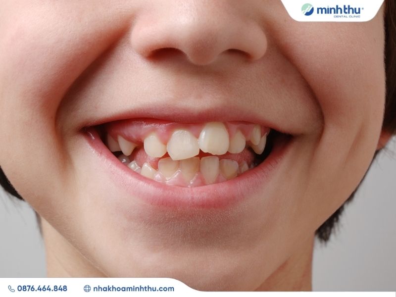 rang-khap-khenh-nguyen-nhan-phuong-phap-dieu-tri