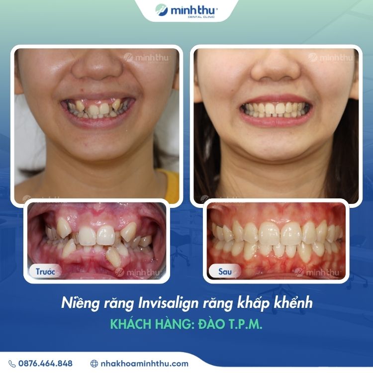 rang-khap-khenh-nguyen-nhan-phuong-phap-dieu-tri