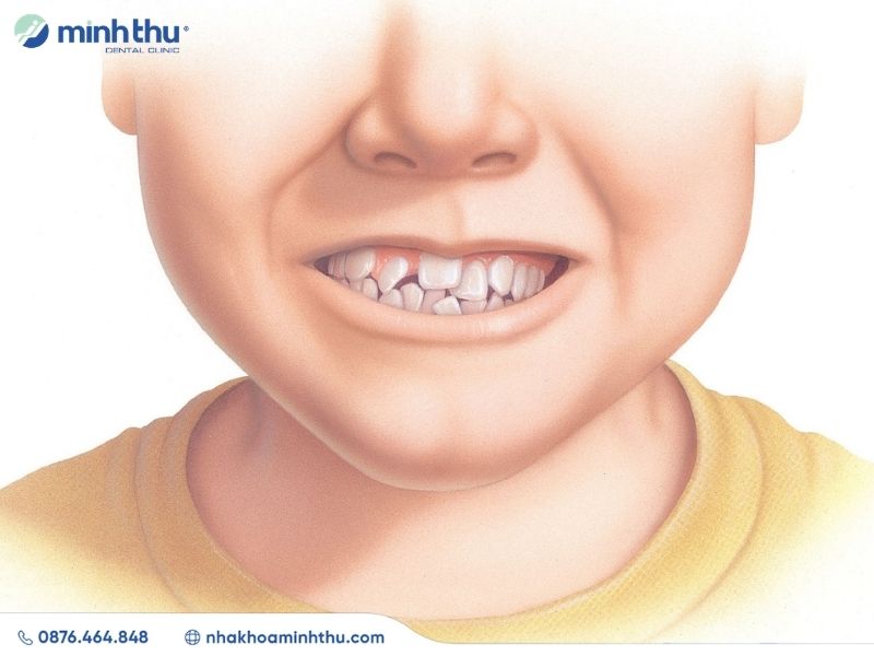 rang-khap-khenh-nguyen-nhan-phuong-phap-dieu-tri