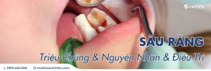 sau-rang-trieu-chung-nguyen-nhan