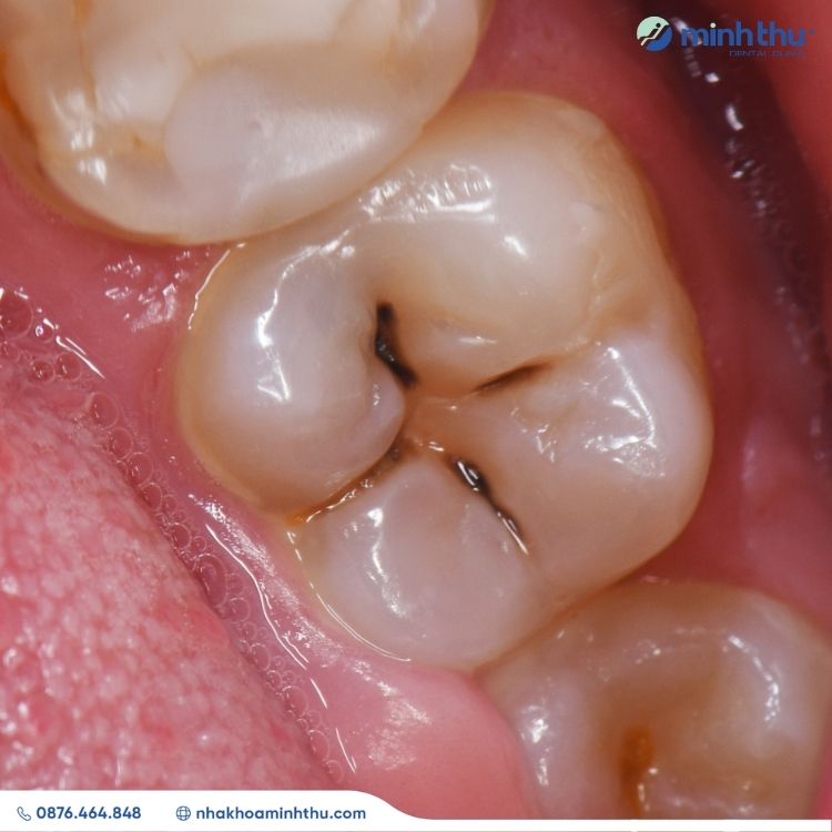 sau-rang-trieu-chung-nguyen-nhan