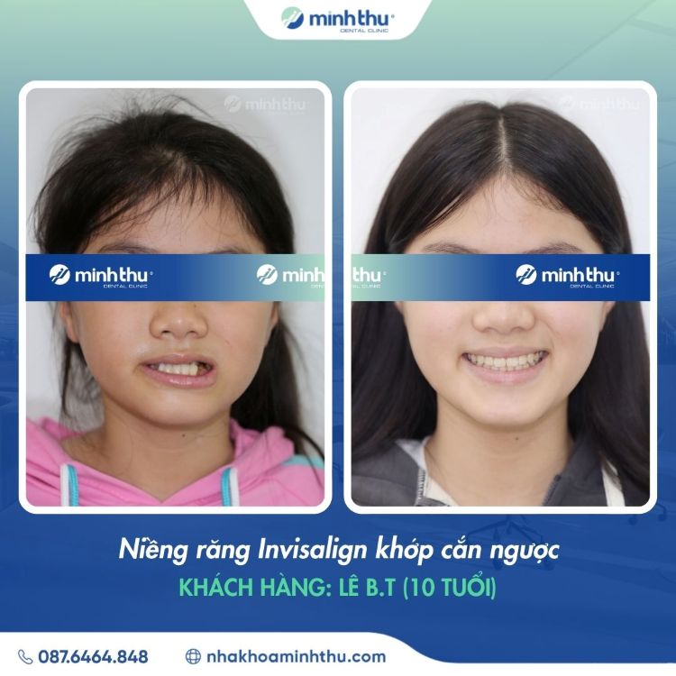 Niềng răng sớm khách hàng Lê Bảo Trang