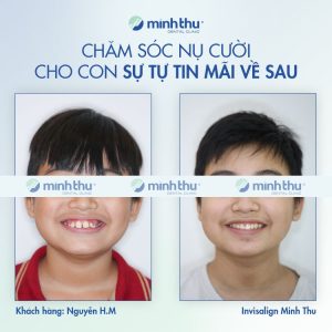 Niềng răng sớm khách hàng Hải Minh