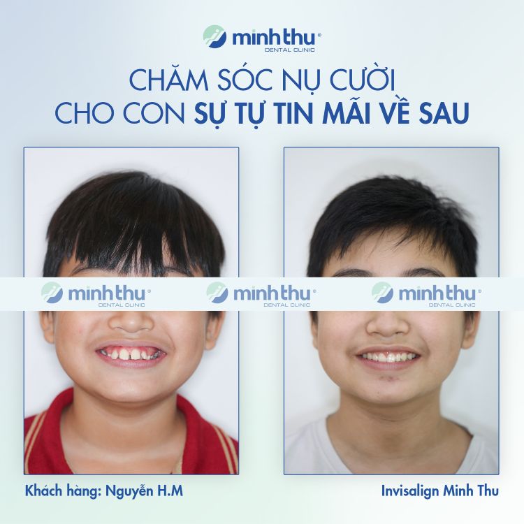 Niềng răng sớm khách hàng Hải Minh