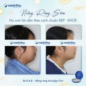 nieng-rang-som-khach-hang