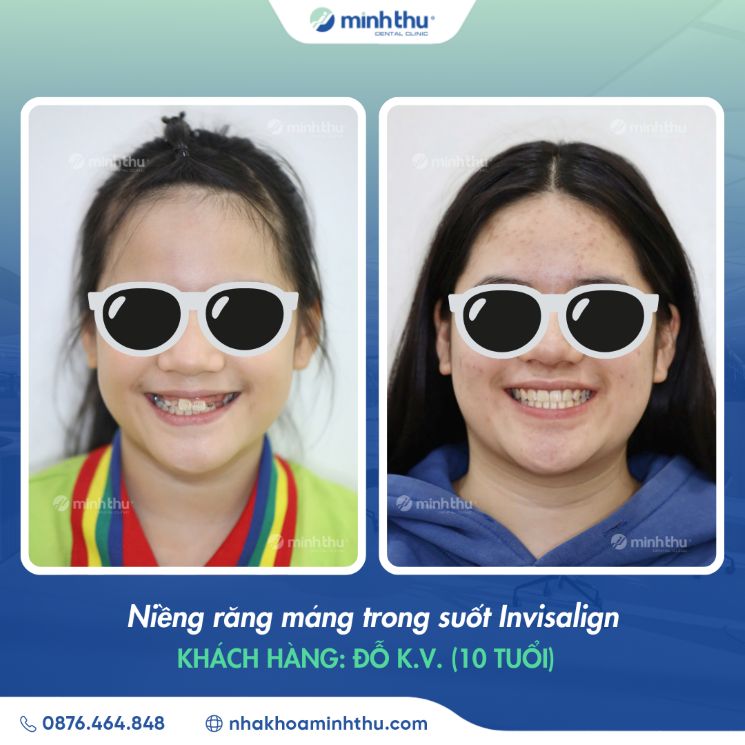 Niềng răng sớm khách hàng Đỗ Khánh Vy