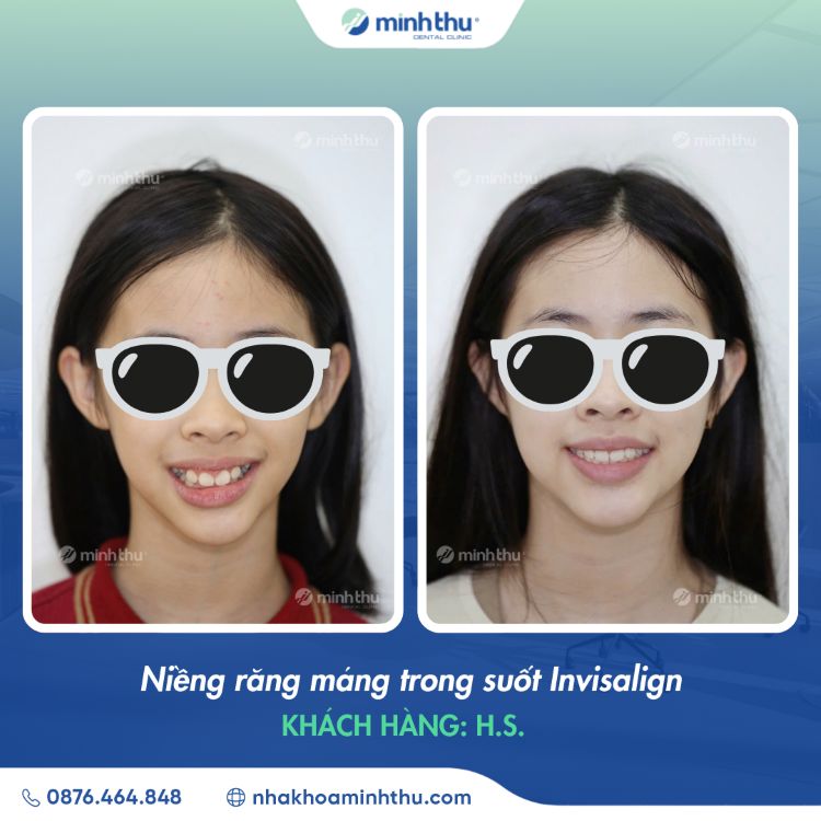 Niềng răng sớm khách hàng Hân San