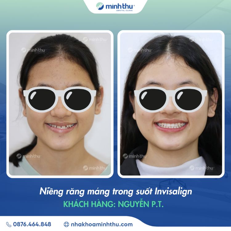Niềng răng sớm khách hàng Nguyễn Phương Thảo