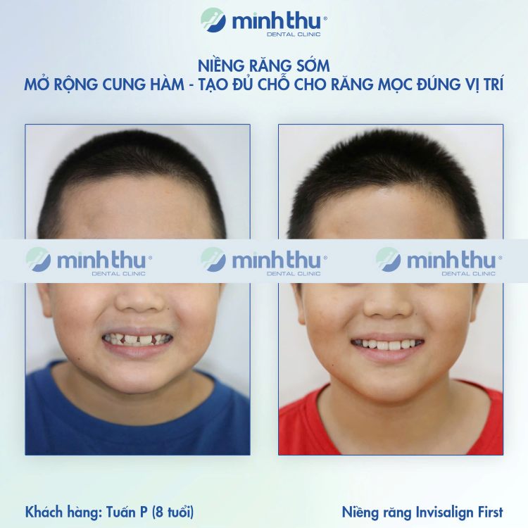 Niềng răng sớm khách hàng Tuấn Phong