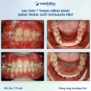 Niềng răng sớm khách hàng Đ.T