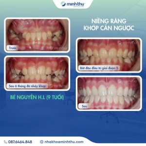 Niềng răng sớm khách hàng h.l
