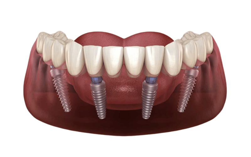 implant all on 4