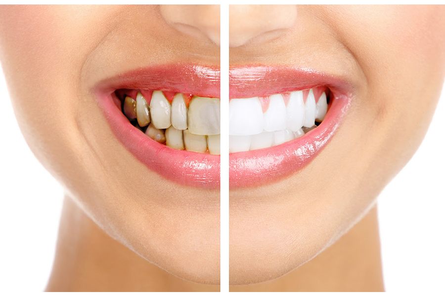tẩy trắng hết bao nhiêu tiền
