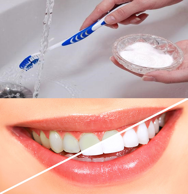 tẩy trắng răng tại nha