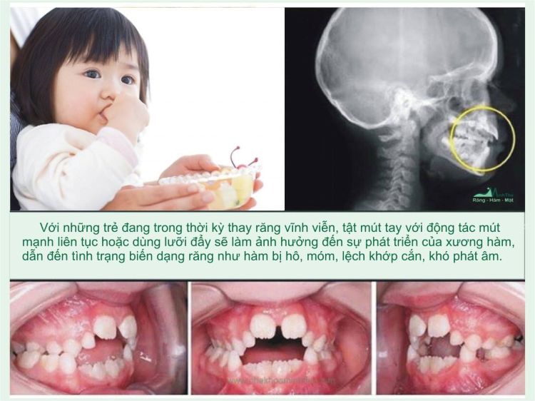 Tác hại của thói quen mút ngón tay Tác hại của thói quen mút ngón tay