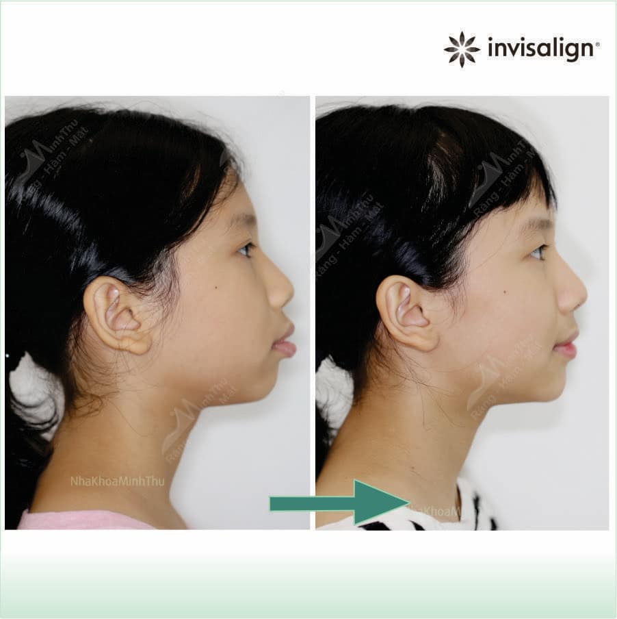 Khách hàng Lê Thu An niềng răng sớm 